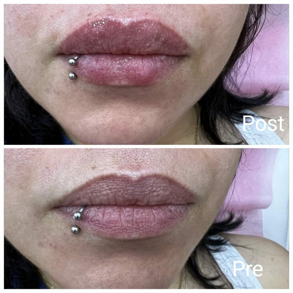 فيلر توريد الشفايف